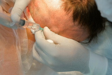 Surgeon in latex gloves making injection of local anesthesia into head of bald patient during hair transplantation procedure. Problem of baldness, treatment of alopecia by hair transplantation.