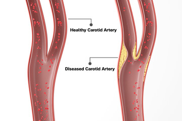 Comparison between healthy and diseased carotid artery