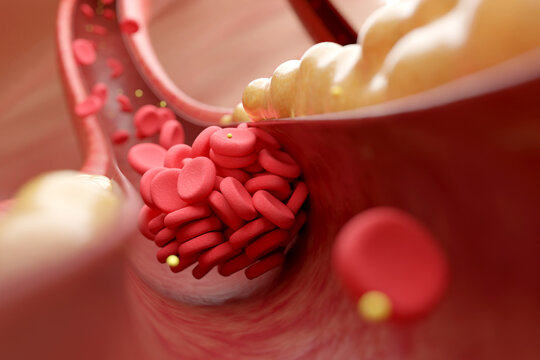 High cholesterol and fatty acids in blood cells causing blood clot block blood flow