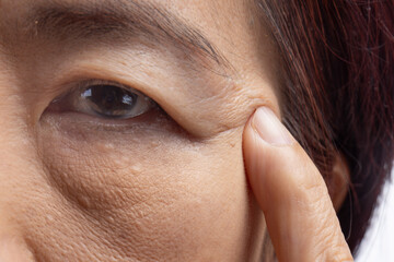 Senior asian woman worry about eye bags and dark spot.