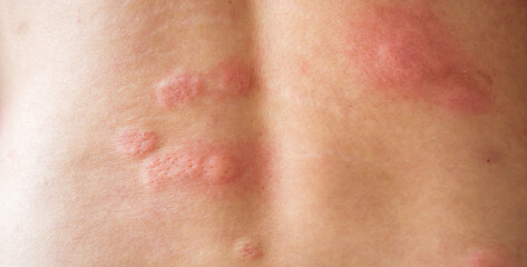 Fototapeta premium Young asian man itching and scratching on his back from allergic itchy dry skin eczema dermatitis insect bites