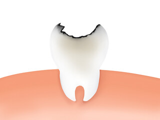 Tooth decay illustration, rotten tooth illustration
