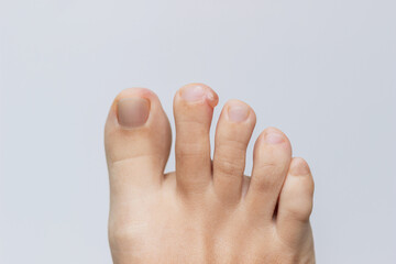 Callus on the female toe from tight shoes on a light grey background. Corns, blisters on the foot