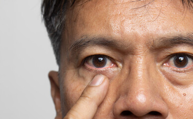 Senior man eye strain after for long stretches at computer or digital screens.