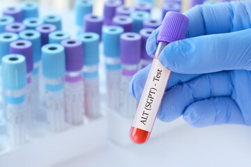 Doctor holding a test blood sample tube with ALT (Alanine Transaminase) or SGPT test on the background of medical test tubes with analyzes