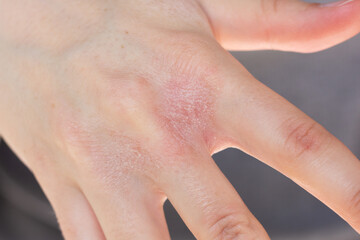 Close-up of a woman’s hands with eczema flare-up between fingers.