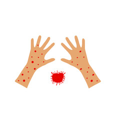 monkeypox virus. hands infected with the monkeypox virus