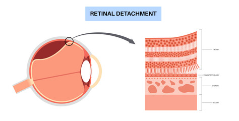 Fototapeta premium Retinal detachment eye disease