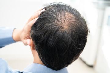 Fototapeta premium Bald in the middle head and begin no loss hair glabrous of mature Asian business smart active office man.
