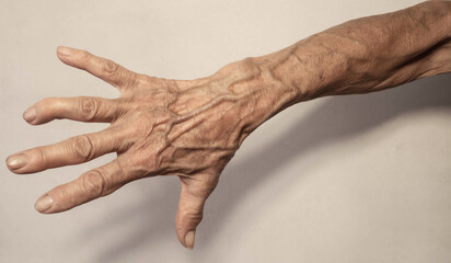 Veins on the arms. Varicose veins on the arms of an elderly woman.