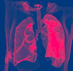Coloured 3D computed tomography (CT) scan of the chest of a 60 year old male patient with shortness...