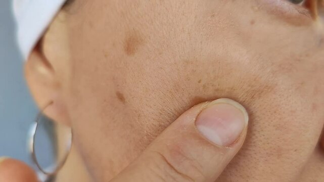 Pigmentation on the face, age spots on the skin from the sun. A woman touches problem stains on her face. Close-up video.