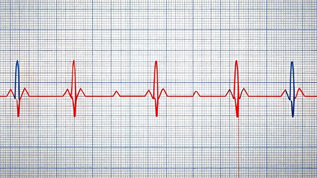High-quality illustration of notched T-waves in an ECG tracing, shown on a minimalist white background with a subtle grid pattern, highlighting the abnormal bifid waveform in bright red and deep blue
