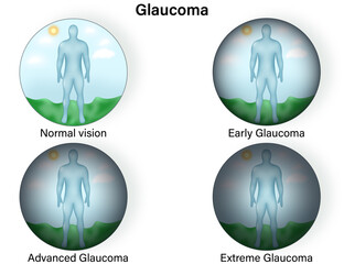 Detailed Science Vector Illustration of Vision in Normal and Glaucoma Eye Conditions, Highlighting Glaucoma Development Stages: Early, Advanced, and Extreme Vision Loss