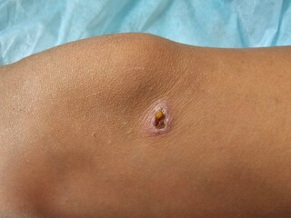 Fototapeta premium Closeup of a knee with a noticeable cyst on the skin in a medical setting during daylight hours