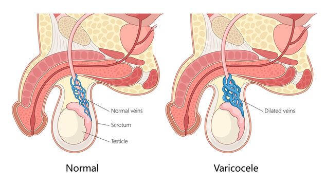 normal veins and varicocele, dilated veins in the scrotum affecting the testicle hand drawn schematic raster illustration. Medical science educational illustration