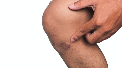 Scar on human skin keloid on knee.	