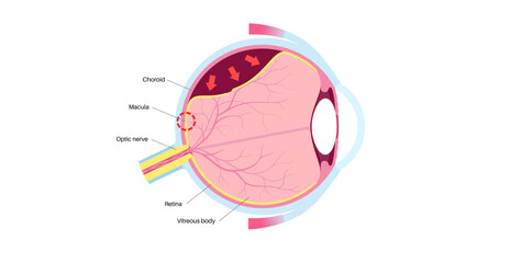Retinal detachment eye disease