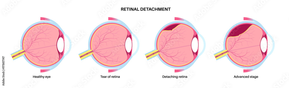 Canvas Prints Retinal detachment eye disease