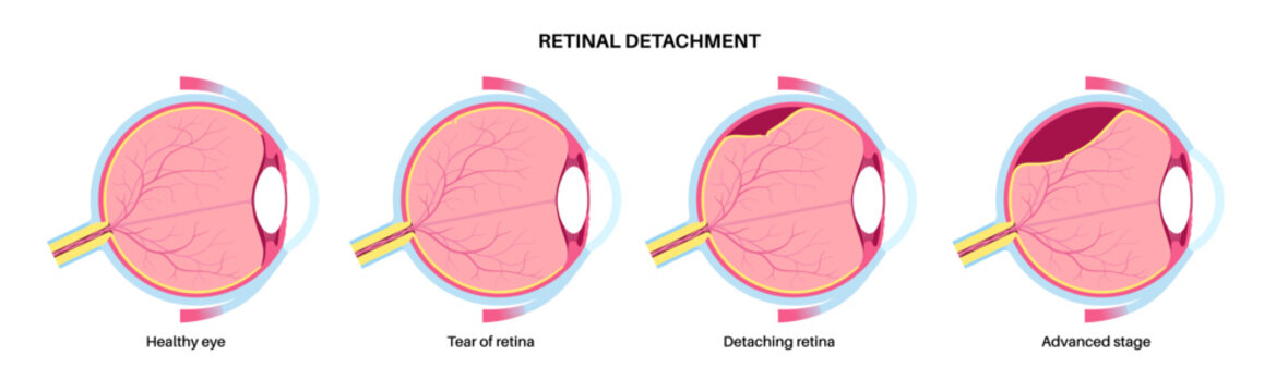 Retinal detachment eye disease
