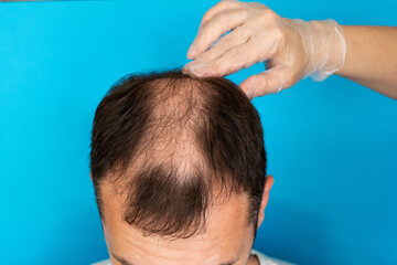 Fototapeta premium Baldness, a man is examined by a doctor in gloves on a blue background close-up.