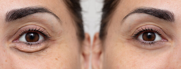 Woman showing before and after eye bags treatment