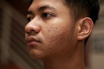 Obraz premium asian boy close up with pimples on cheeks due to allergies and excess androgen hormone.