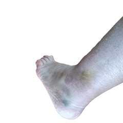swelling of the leg after a fracture leg of a person after a cast