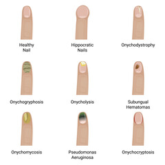 Nail diseases vector illustration design.