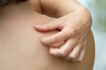 Fototapeta premium Woman scratching her itchy back with hand