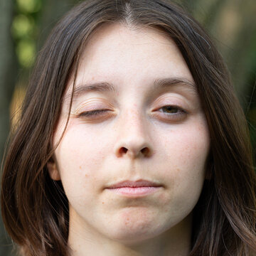 close up on brown eyes girl face with one half closed eye, due to Myasthenia gravis