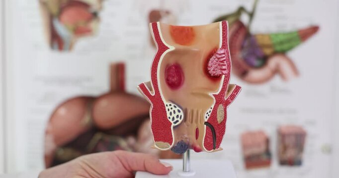 Anatomy of anus and treatment of diseases of rectum with hemorrhoids. Proctologist and rectal pathology on anatomical model