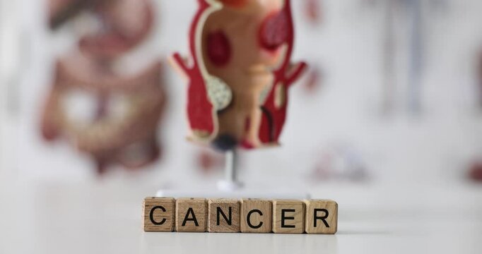 Word cancer on cubes on background of anatomical model of rectum. Colon cancer symptoms and treatment