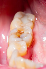 Cracked second molar tooth in need of a crown with a shallow depth of field