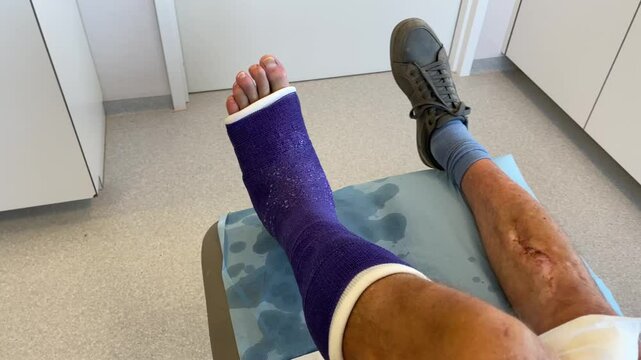 Man with a broken leg in a purple fiberglass cast sits on a sofa in a hospital, high quality 4K footage