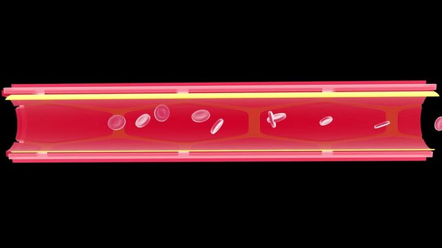 3d animation of the anatomical interior of an artery. Obstructed by the accumulation of fat that prevents the normal movement of red blood cells that accumulate, making a thrombus. Capillary on black 