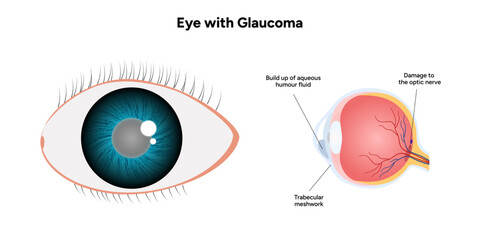 Eye with glaucoma disease, medical infographic with human eye optic anatomy