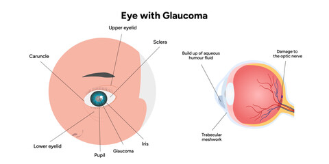 Eye with glaucoma disease, medical infographic with human eye optic anatomy