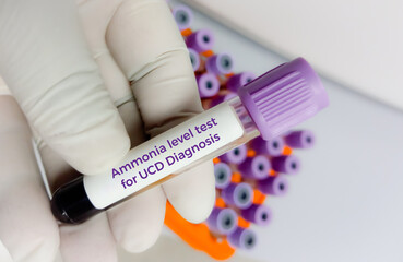 Ammonia level test for the diagnosis of Urea Cycle Disorder (UCD).