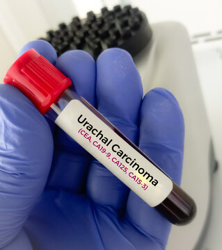 Blood sample for Urachal cancer or Urachal carcinoma blood test(CEA, CA19-9, CA125, CA15-3) , a rare type of non urothelial malignancy, that arises from the urachal ligament.