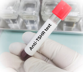 Blood sample for Anti TSHR Ab test. Thyroid stimulating Immunoglobulin test. Throtropin binding inhibitory Immunoglobulin.