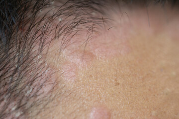 Scalp fungal infection that causes skin disease at the head, skin on the scalp to flake,Dandruff in the hair, Flaky scalp, Seborrhea. 