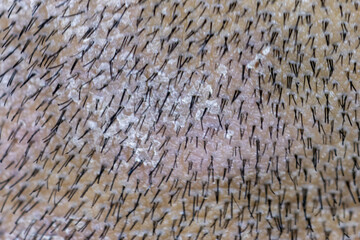 Scalp fungal infection that causes skin disease at the head, skin on the scalp to flake,Dandruff in the hair, Flaky scalp, Seborrhea. 