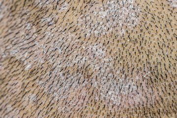 Scalp fungal infection that causes skin disease at the head, skin on the scalp to flake,Dandruff in the hair, Flaky scalp, Seborrhea. 