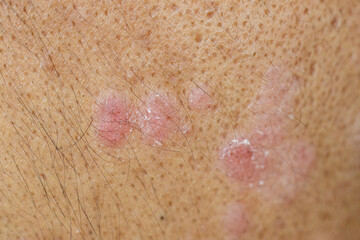 Fototapeta premium Scalp fungal infection that causes skin disease at the head, skin on the scalp to flake,Dandruff in the hair, Flaky scalp, Seborrhea. 