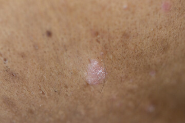 Scalp fungal infection that causes skin disease at the head, skin on the scalp to flake,Dandruff in the hair, Flaky scalp, Seborrhea. 