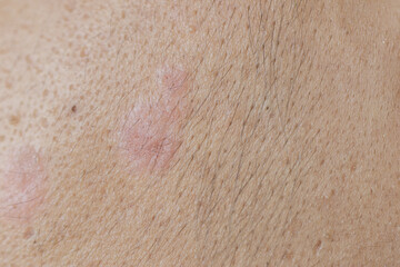 Fototapeta premium Scalp fungal infection that causes skin disease at the head, skin on the scalp to flake,Dandruff in the hair, Flaky scalp, Seborrhea. 