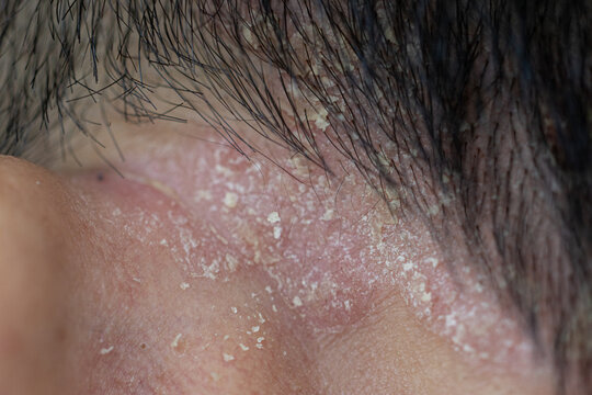 Scalp fungal infection that causes skin disease at the head, skin on the scalp to flake,Dandruff in the hair, Flaky scalp, Seborrhea. 