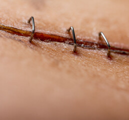 Staples surgical incision healing scar transplant operation closeup