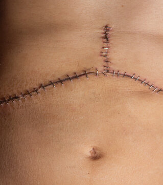 Staples surgical incision healing scar transplant operation closeup